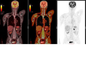 פענוח pet ct