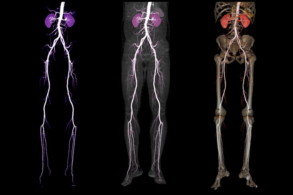 ייעוץ ברדיולוגיה פולשנית לטיפול במחלות כלי דם